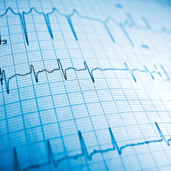 EKG Output